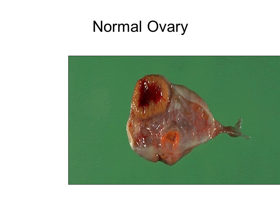 Normal Ovary