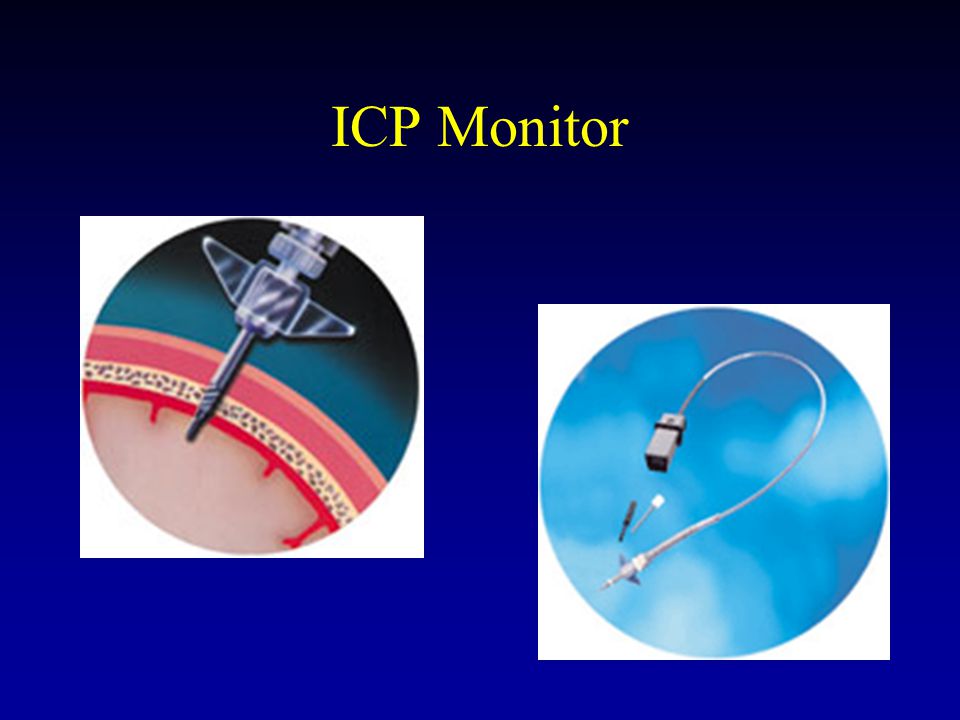 ICP Monitor