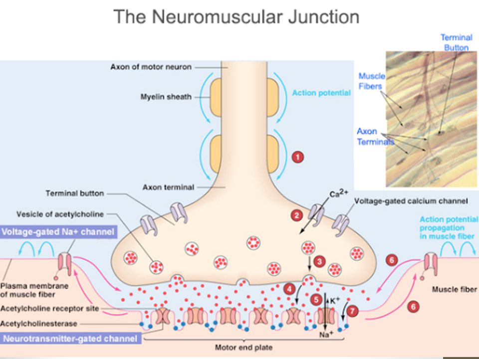 myasthenia gravis neuromuscular disorder caused by