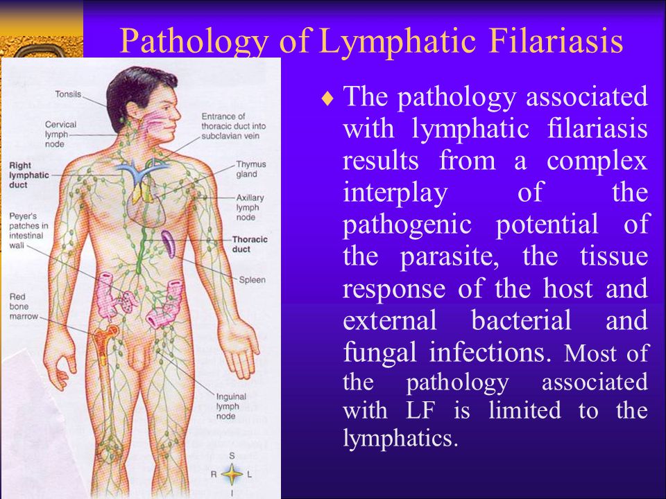 Image result for lymphatic filariasis pic