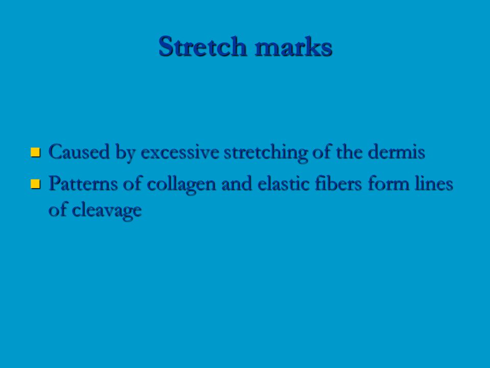 Caused by excessive stretching of the dermis Caused by excessive stretching of the dermis Patterns of collagen and elastic fibers form lines of cleavage Patterns of collagen and elastic fibers form lines of cleavage Stretch marks