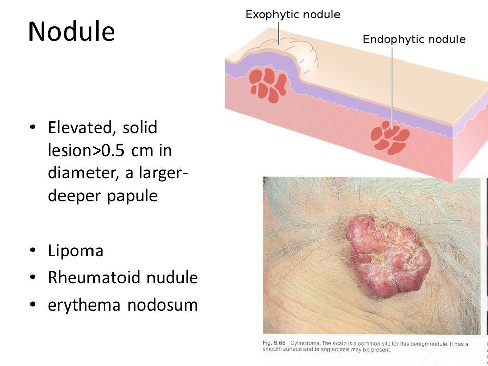 LIPOMA PPT lipoma ppt: