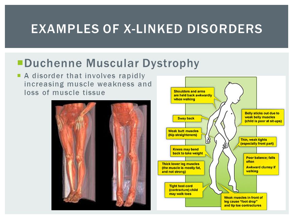 understanding duchenne muscular dystrophy and its causes Duchenne muscular dystrophy harish hosalkar md, mbms (orth), fcps (orth), dnb (orth) introduction duchenne muscular dystrophy (dmd) is the most common form of muscular dystrophy it is a x-linked recessive myopathy generally affecting only males it. understanding duchenne muscular dystrophy and its causes Duchenne muscular dystrophy harish hosalkar md, mbms (orth), fcps (orth), dnb (orth) introduction duchenne muscular dystrophy (dmd) is the most common form of muscular dystrophy it is a x-linked recessive myopathy generally affecting only males it.