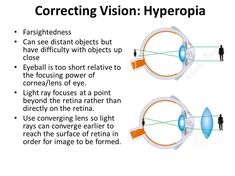 Correcting Vision: Hyperopia Farsightedness Can see distant objects but have difficulty with objects up close Eyeball is too short relative to the focusing power of cornea/lens of eye.