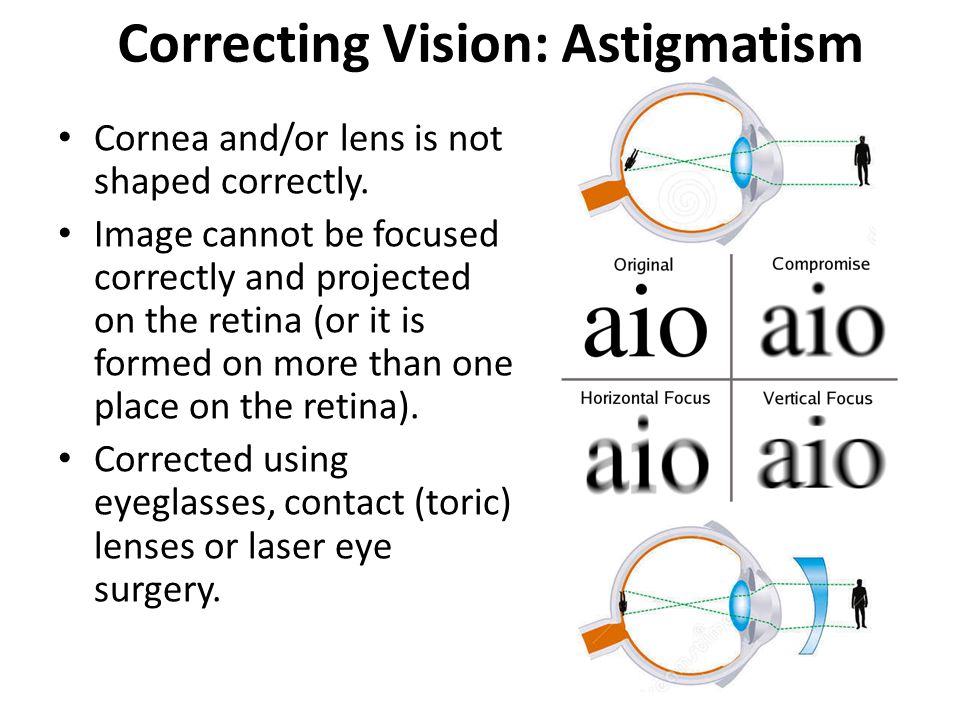 Correcting Vision: Astigmatism Cornea and/or lens is not shaped correctly.