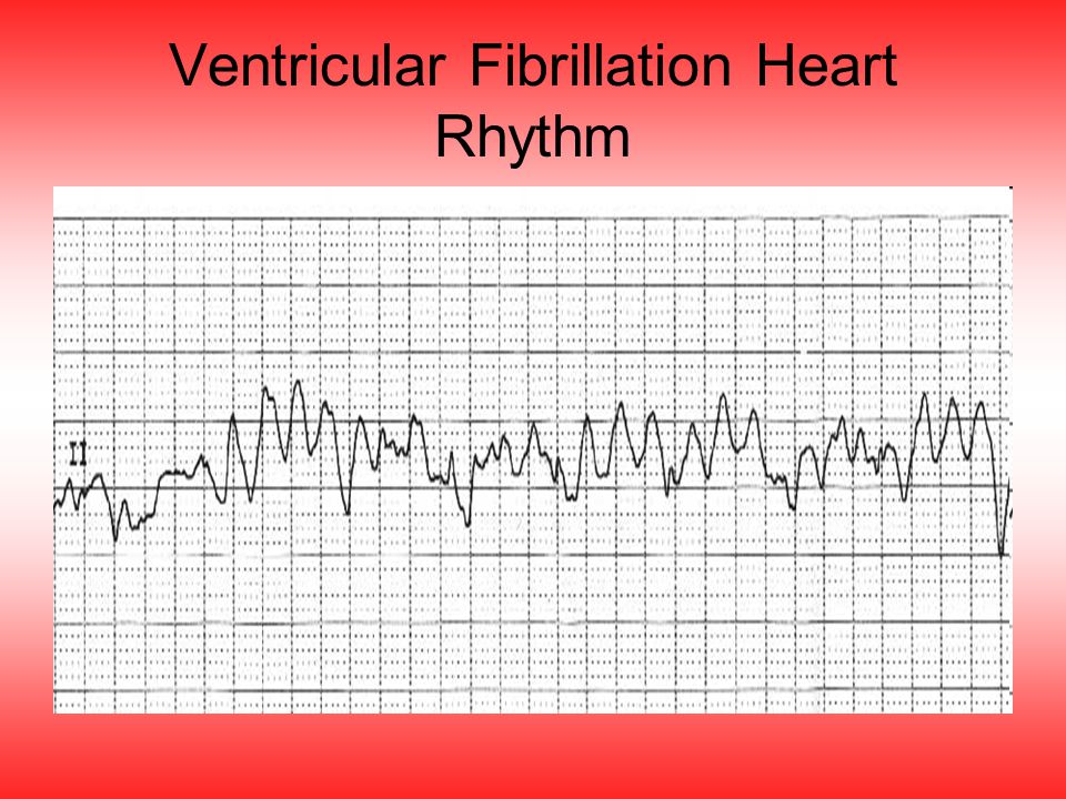 Ventricular Fibrillation Heart Rhythm