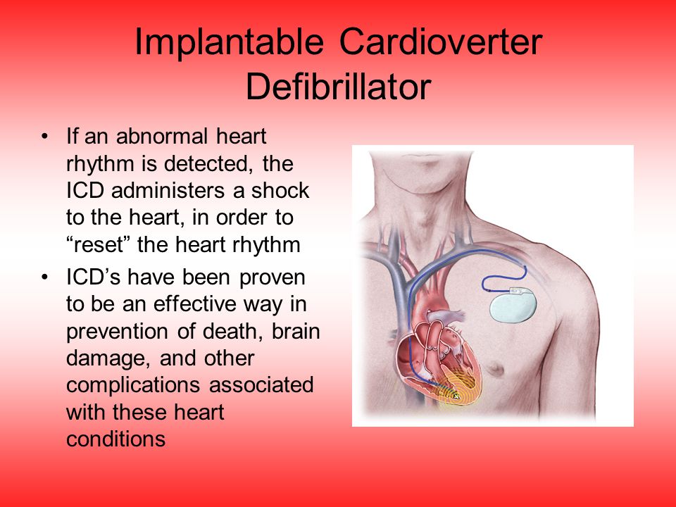 Implantable Cardioverter Defibrillator If an abnormal heart rhythm is detected, the ICD administers a shock to the heart, in order to reset the heart rhythm ICD’s have been proven to be an effective way in prevention of death, brain damage, and other complications associated with these heart conditions