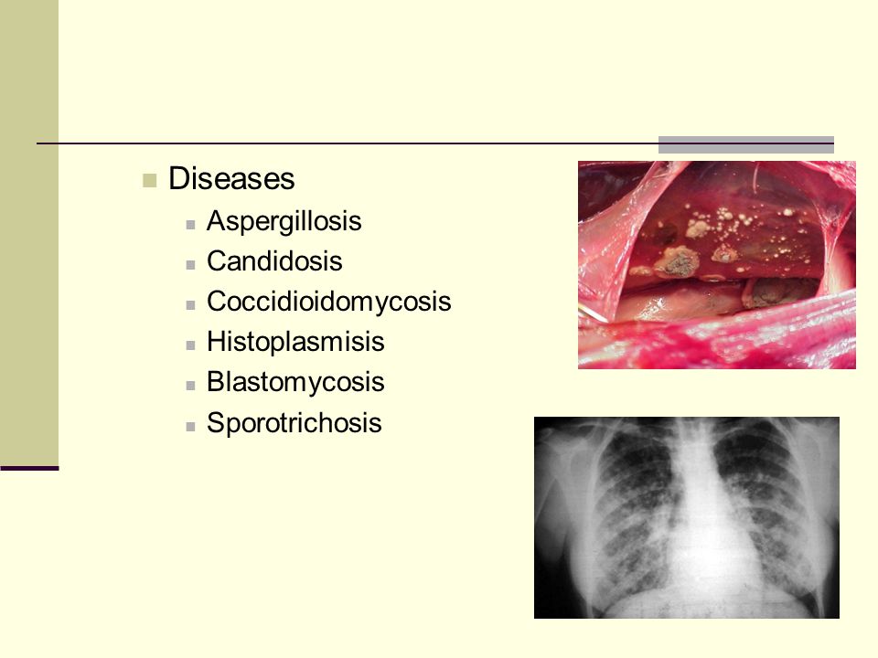 Diseases Aspergillosis Candidosis Coccidioidomycosis Histoplasmisis Blastomycosis Sporotrichosis