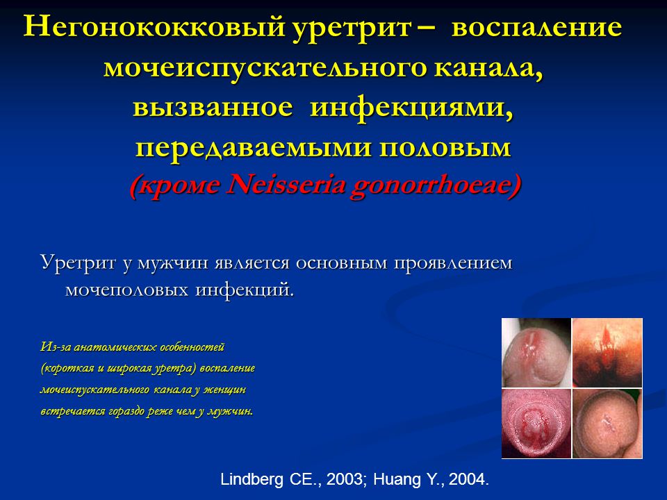 Лечение уретрита мужчин домашних условиях - ТД Мануфактура