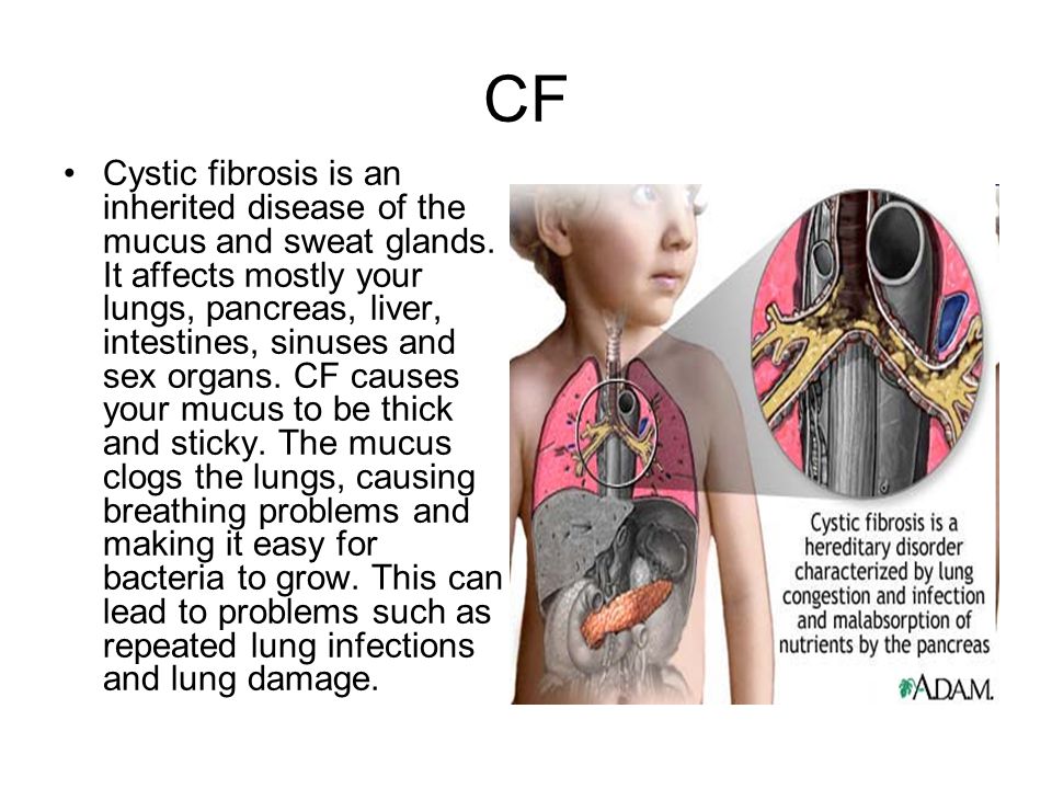 CF Cystic fibrosis is an inherited disease of the mucus and sweat glands.