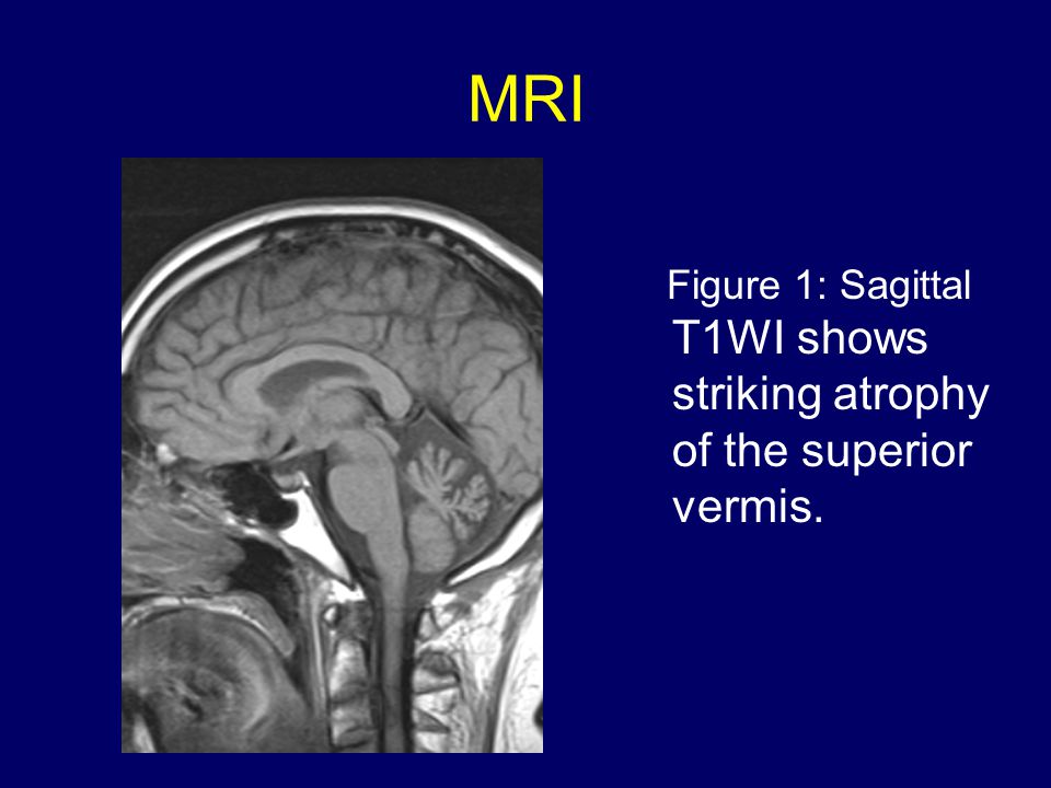 MRI Figure 1: Sagittal T1WI shows striking atrophy of the superior vermis.