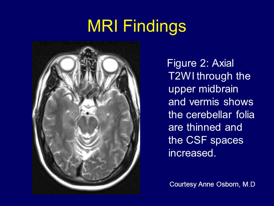 MRI Findings Figure 2: Axial T2WI through the upper midbrain and vermis shows the cerebellar folia are thinned and the CSF spaces increased.