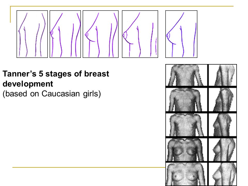 Pubescent breast development gallery