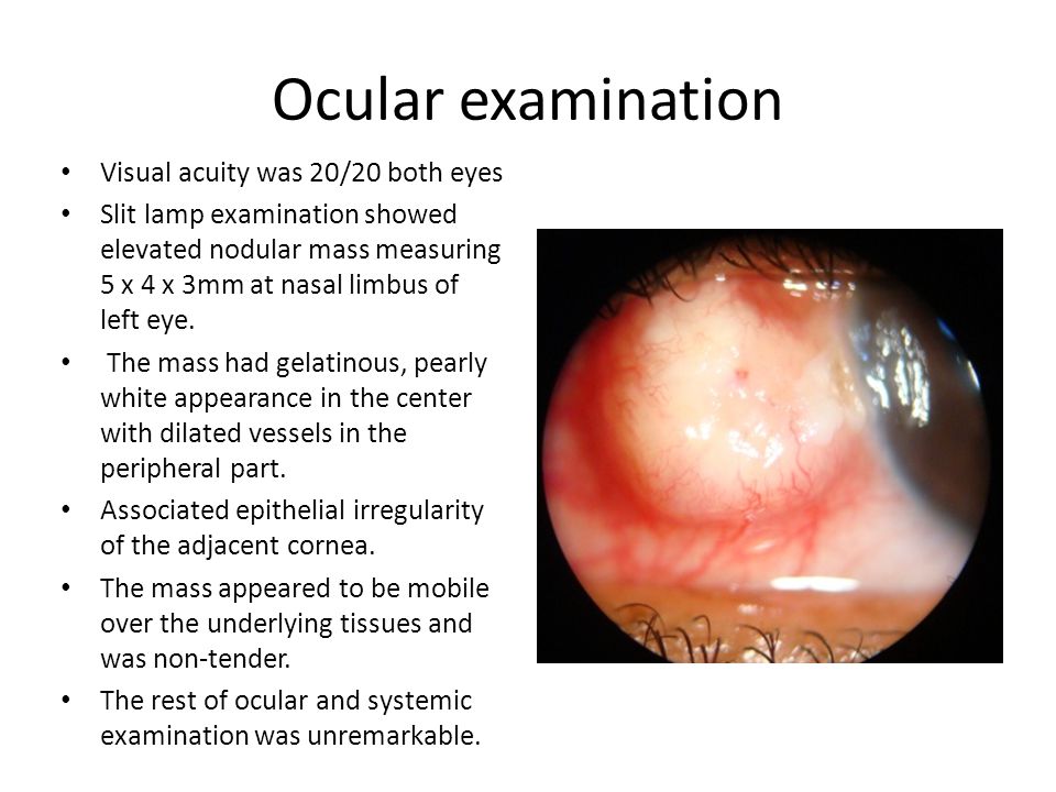 Ocular examination Visual acuity was 20/20 both eyes Slit lamp examination showed elevated nodular mass measuring 5 x 4 x 3mm at nasal limbus of left eye.