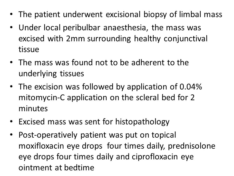 The patient underwent excisional biopsy of limbal mass Under local peribulbar anaesthesia, the mass was excised with 2mm surrounding healthy conjunctival tissue The mass was found not to be adherent to the underlying tissues The excision was followed by application of 0.04% mitomycin-C application on the scleral bed for 2 minutes Excised mass was sent for histopathology Post-operatively patient was put on topical moxifloxacin eye drops four times daily, prednisolone eye drops four times daily and ciprofloxacin eye ointment at bedtime