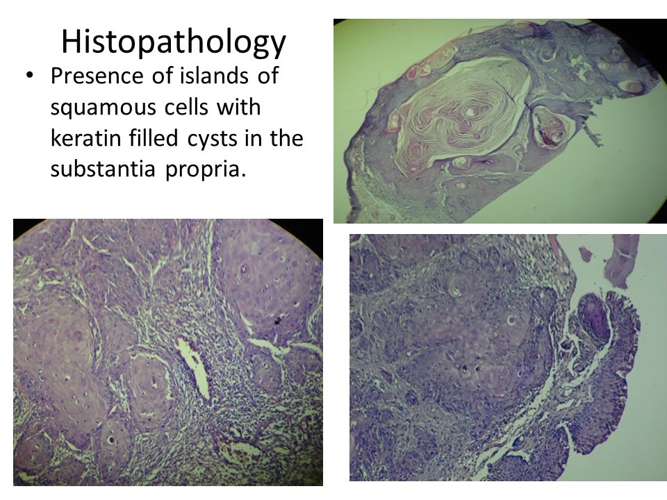 Histopathology Presence of islands of squamous cells with keratin filled cysts in the substantia propria.
