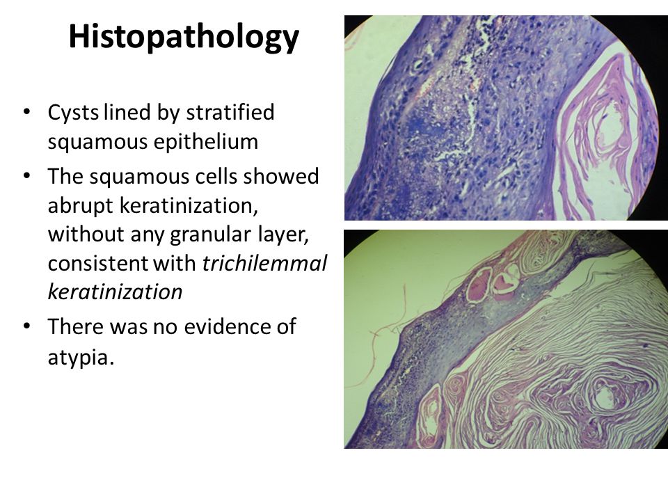 Histopathology Cysts lined by stratified squamous epithelium The squamous cells showed abrupt keratinization, without any granular layer, consistent with trichilemmal keratinization There was no evidence of atypia.