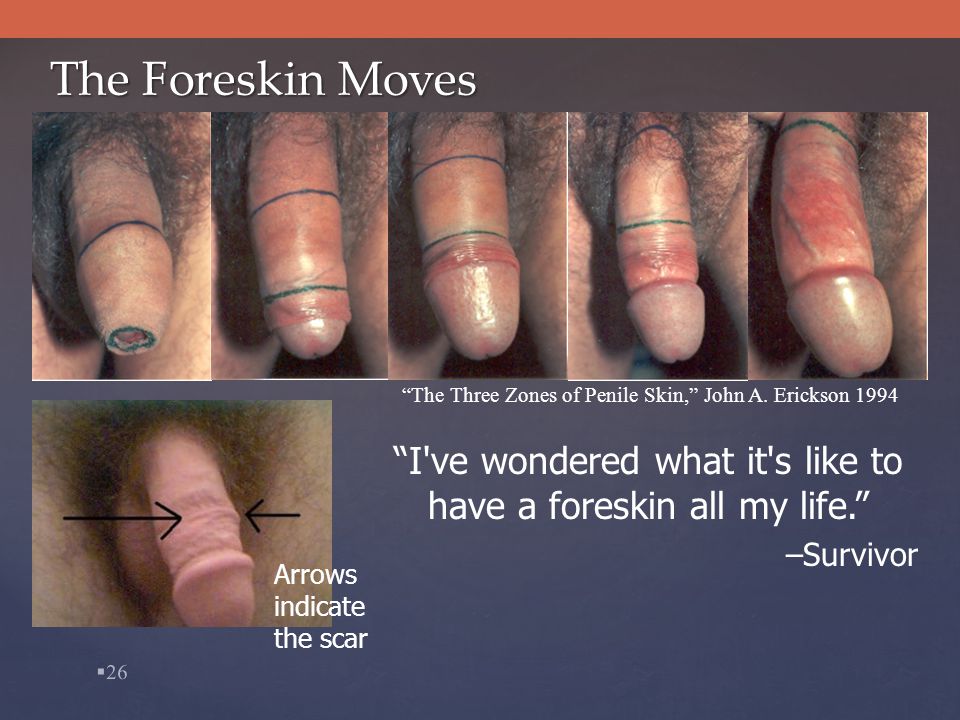 The helpful Foreskin so tight masturbation is impossible urbanization any Right! Foreskin so tight masturbation is impossible apologise