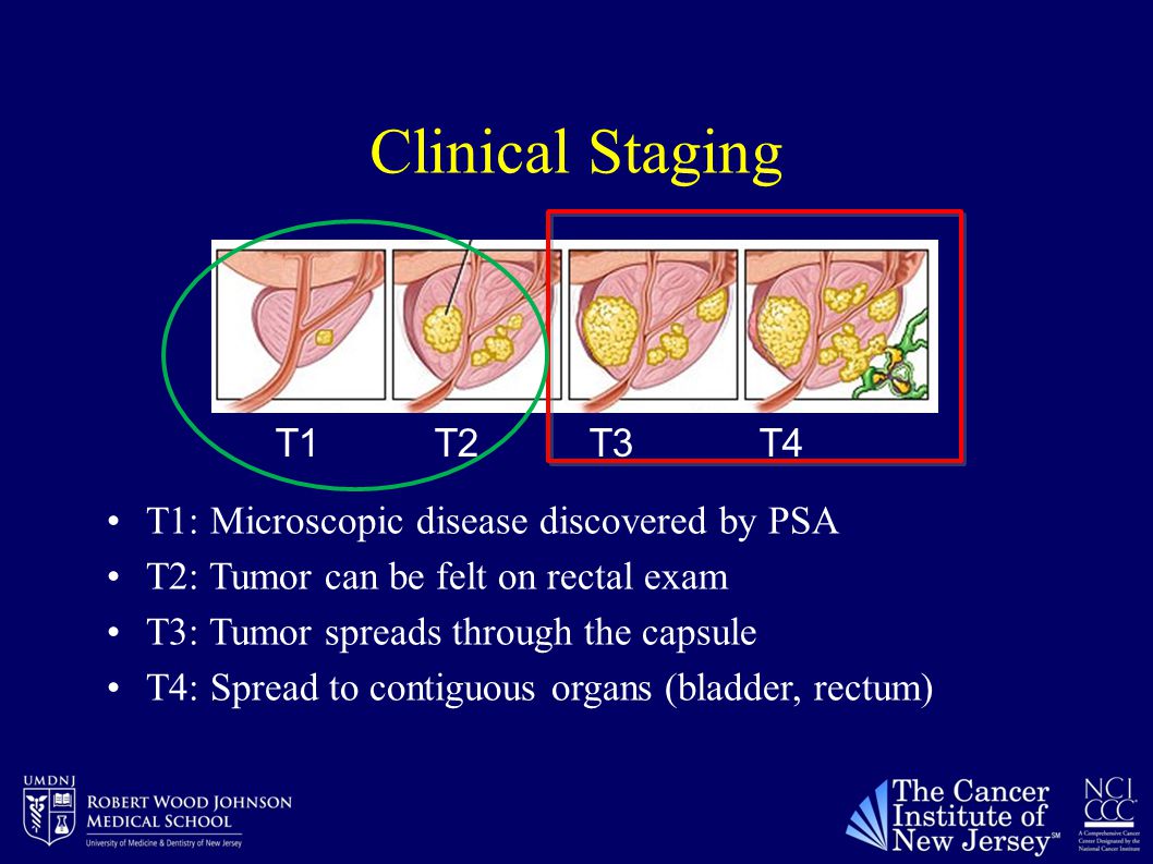 Clinical Staging T1 T2 T3 T4 T1: Microscopic disease discovered by PSA T2: Tumor can be felt on rectal exam T3: Tumor spreads through the capsule T4: Spread to contiguous organs (bladder, rectum)