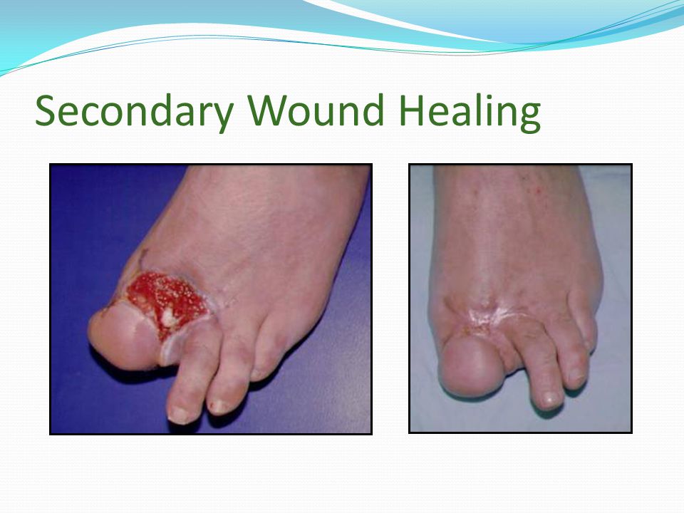 three stages of skin graft healing