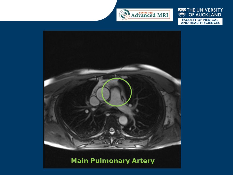 Main Pulmonary Artery