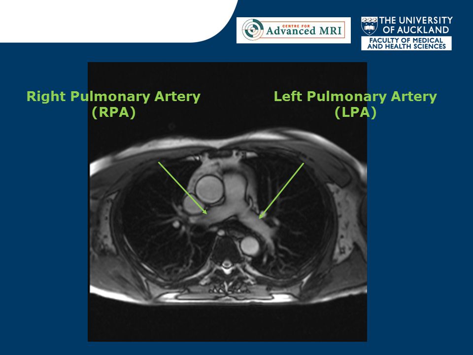 Right Pulmonary Artery (RPA) Left Pulmonary Artery (LPA)