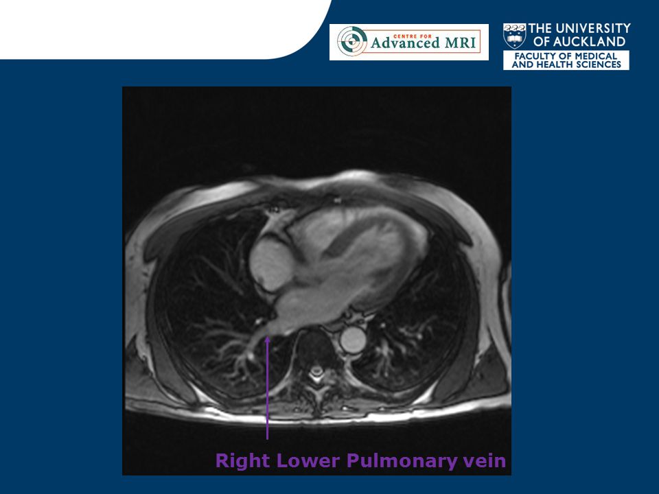 Right Lower Pulmonary vein