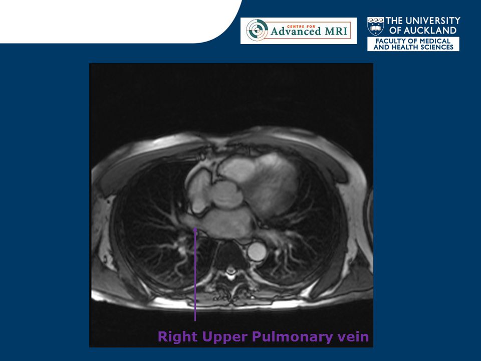 Right Upper Pulmonary vein