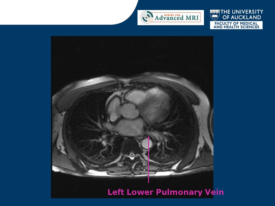 Left Lower Pulmonary Vein