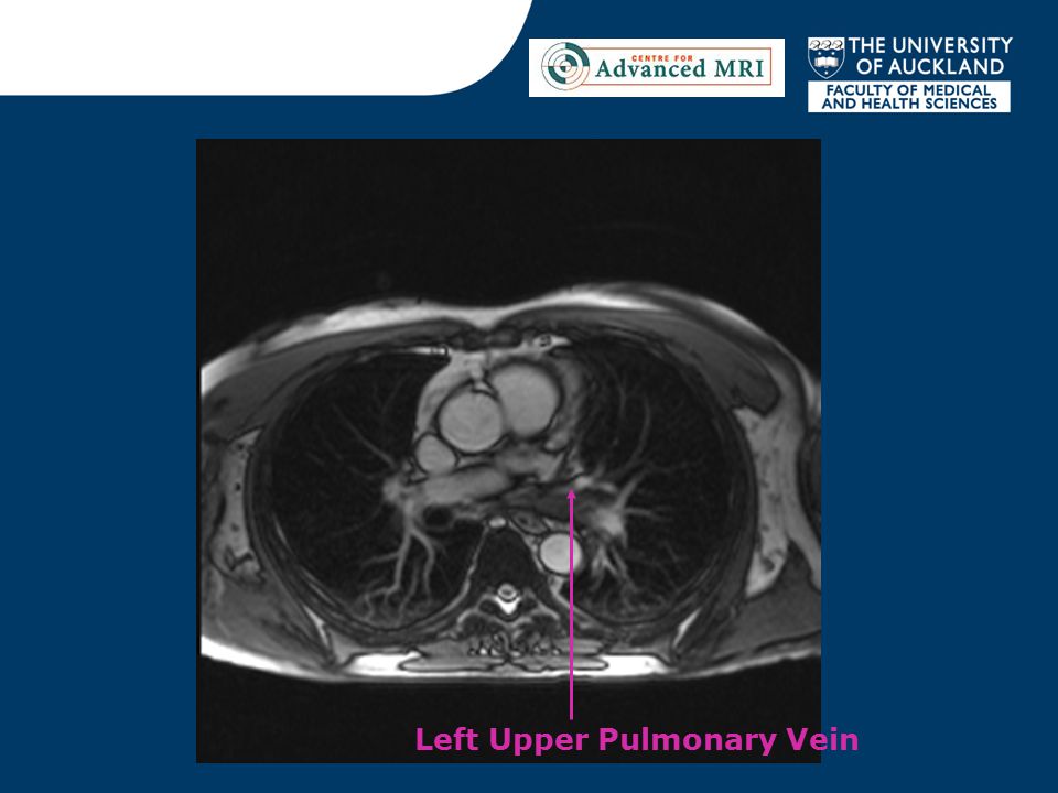 Left Upper Pulmonary Vein