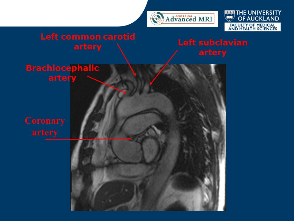 Brachiocephalic artery Left common carotid artery Left subclavian artery Coronary artery