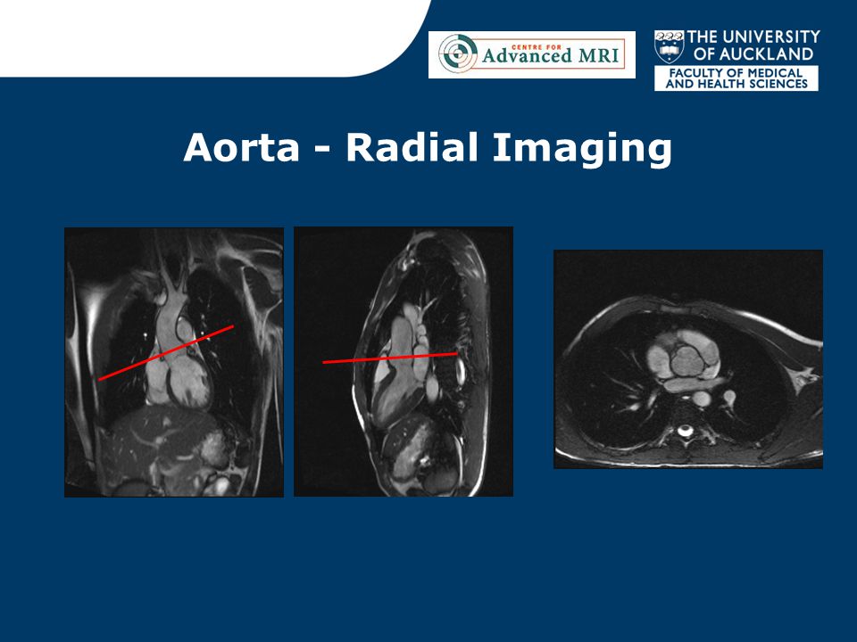 Aorta - Radial Imaging