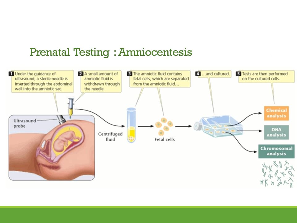 Prenatal Testing : Amniocentesis