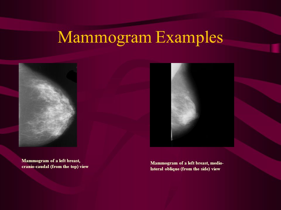 a computer aided detection system for mammograms