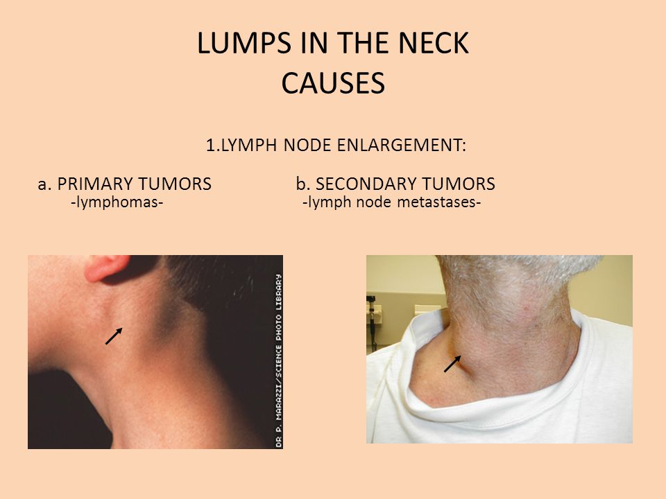 Branchial cysts in adults