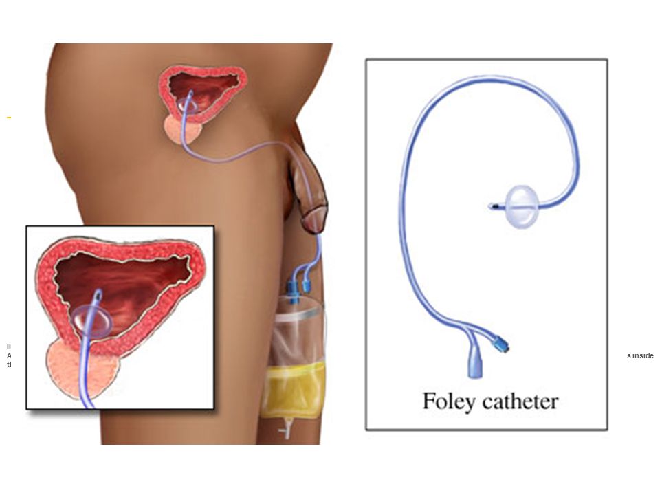 straight catheterization
