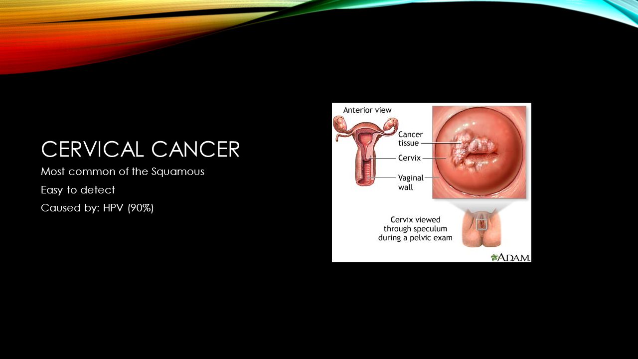Cervical Cancer Specialists