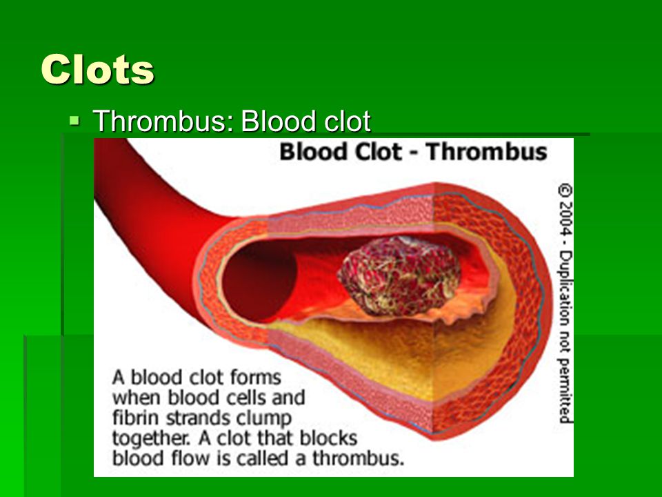 Clots  Thrombus: Blood clot