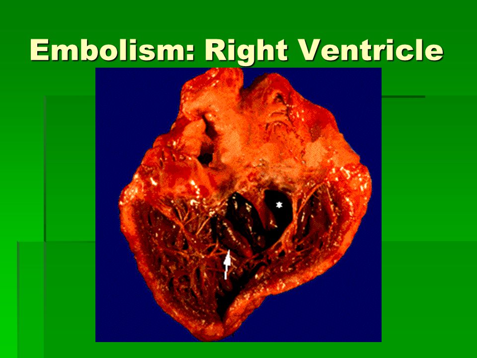 Embolism: Right Ventricle