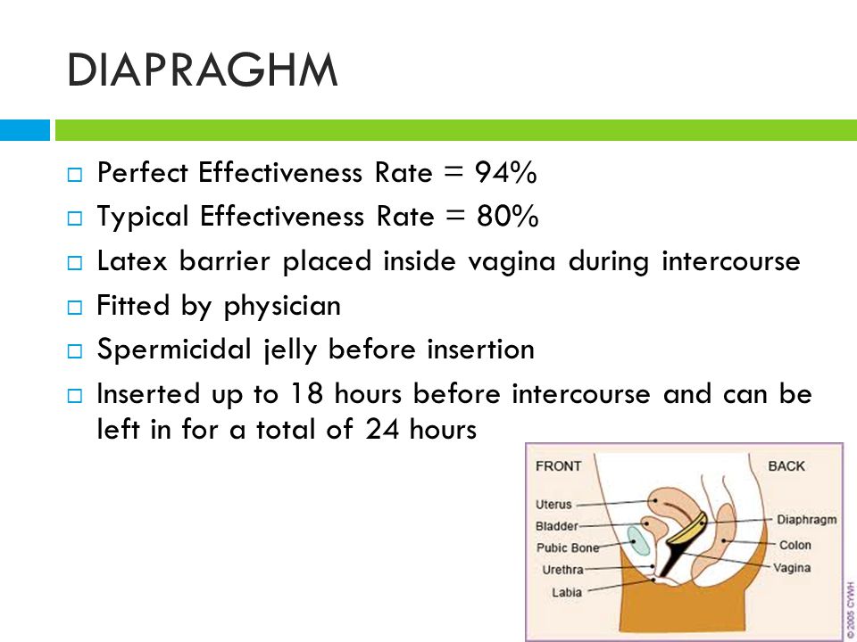 DIAPRAGHM  Perfect Effectiveness Rate = 94%  Typical Effectiveness Rate = 80%  Latex barrier placed inside vagina during intercourse  Fitted by physician  Spermicidal jelly before insertion  Inserted up to 18 hours before intercourse and can be left in for a total of 24 hours