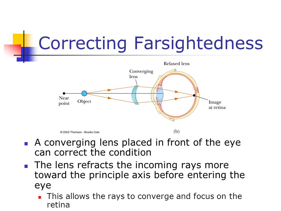 Correcting Farsightedness A converging lens placed in front of the eye can correct the condition The lens refracts the incoming rays more toward the principle axis before entering the eye This allows the rays to converge and focus on the retina