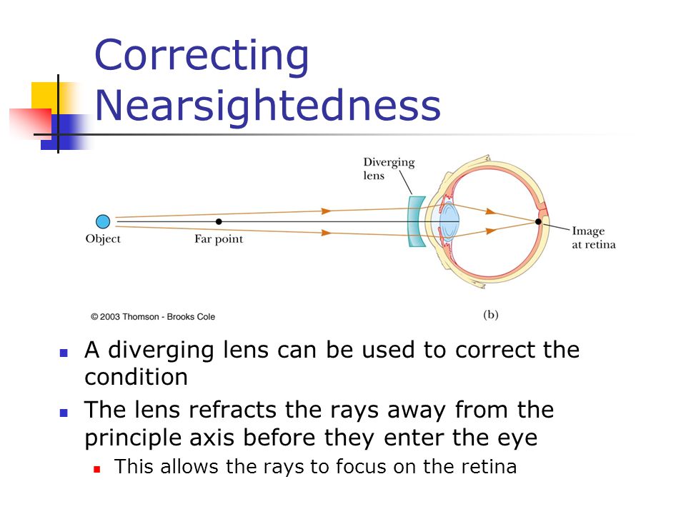 Correcting Nearsightedness A diverging lens can be used to correct the condition The lens refracts the rays away from the principle axis before they enter the eye This allows the rays to focus on the retina