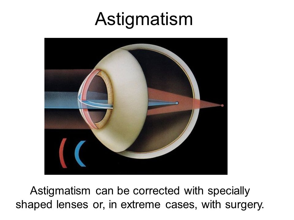 Astigmatism Astigmatism can be corrected with specially shaped lenses or, in extreme cases, with surgery.