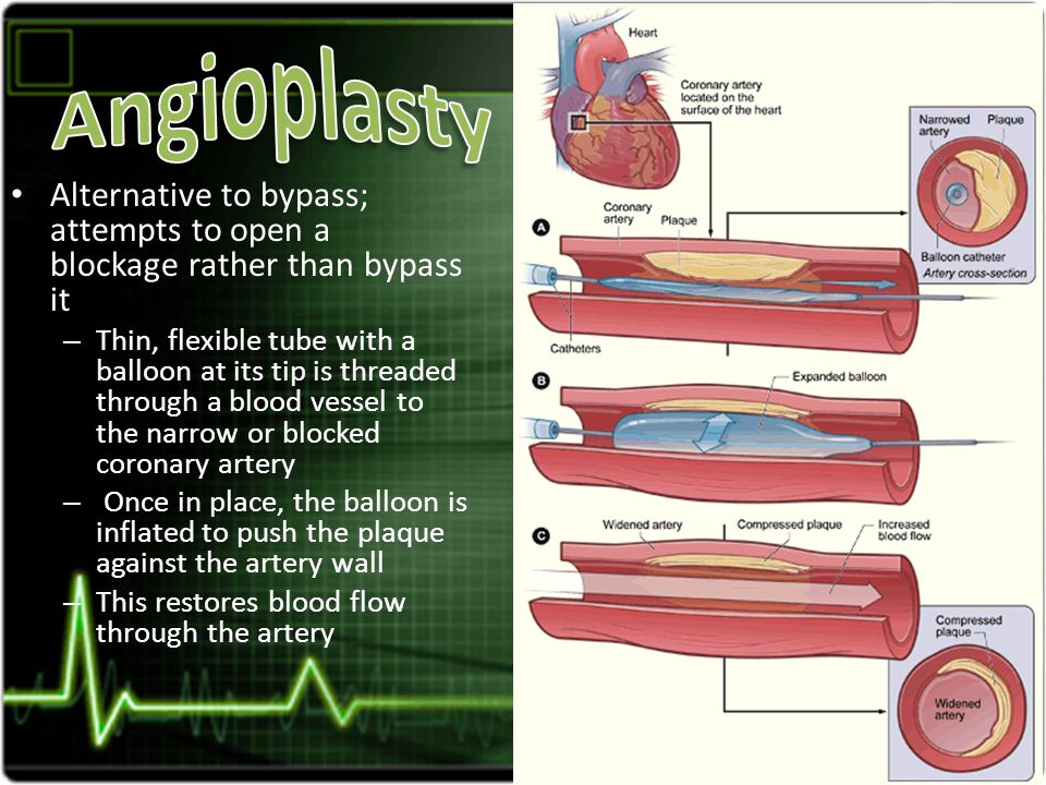 Alternative to bypass; attempts to open a blockage rather than bypass it – Thin, flexible tube with a balloon at its tip is threaded through a blood vessel to the narrow or blocked coronary artery – Once in place, the balloon is inflated to push the plaque against the artery wall – This restores blood flow through the artery