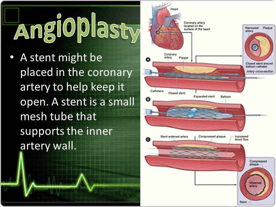 A stent might be placed in the coronary artery to help keep it open.