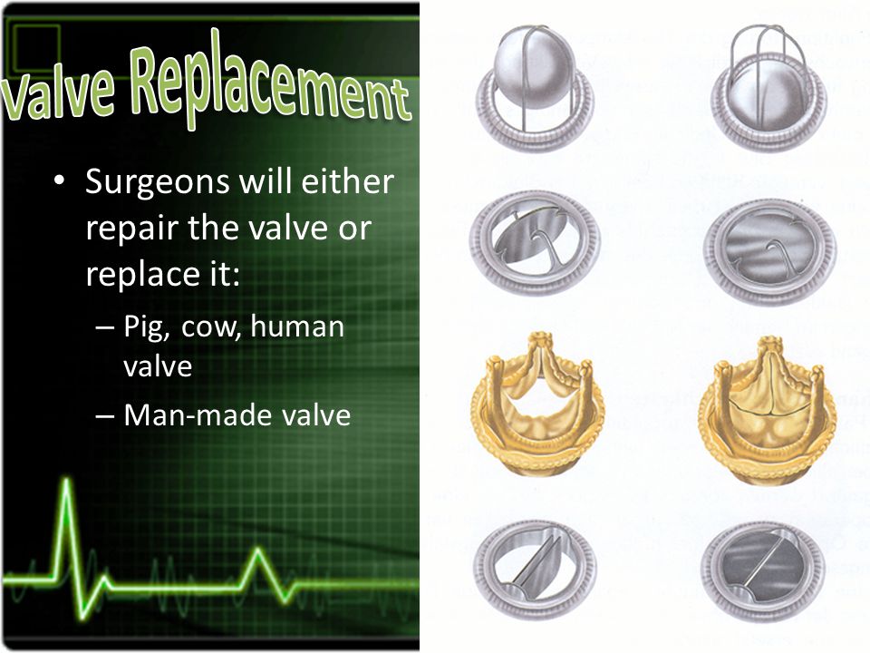 Surgeons will either repair the valve or replace it: – Pig, cow, human valve – Man-made valve