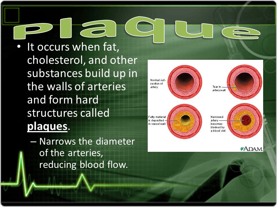 It occurs when fat, cholesterol, and other substances build up in the walls of arteries and form hard structures called plaques.