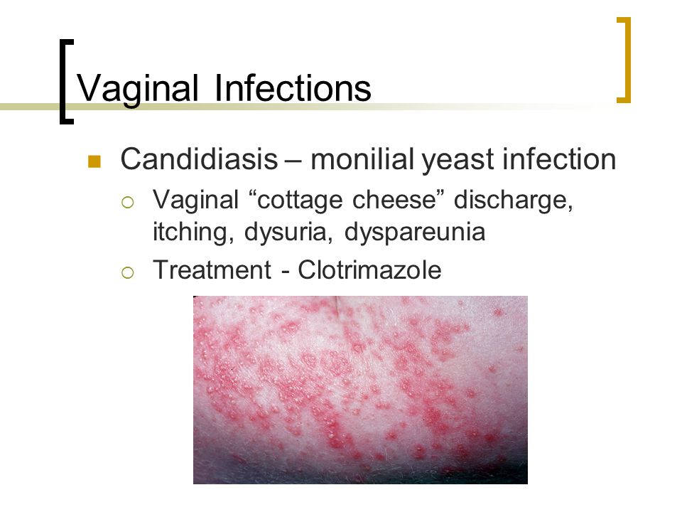 Does diabetes cause vaginal itching