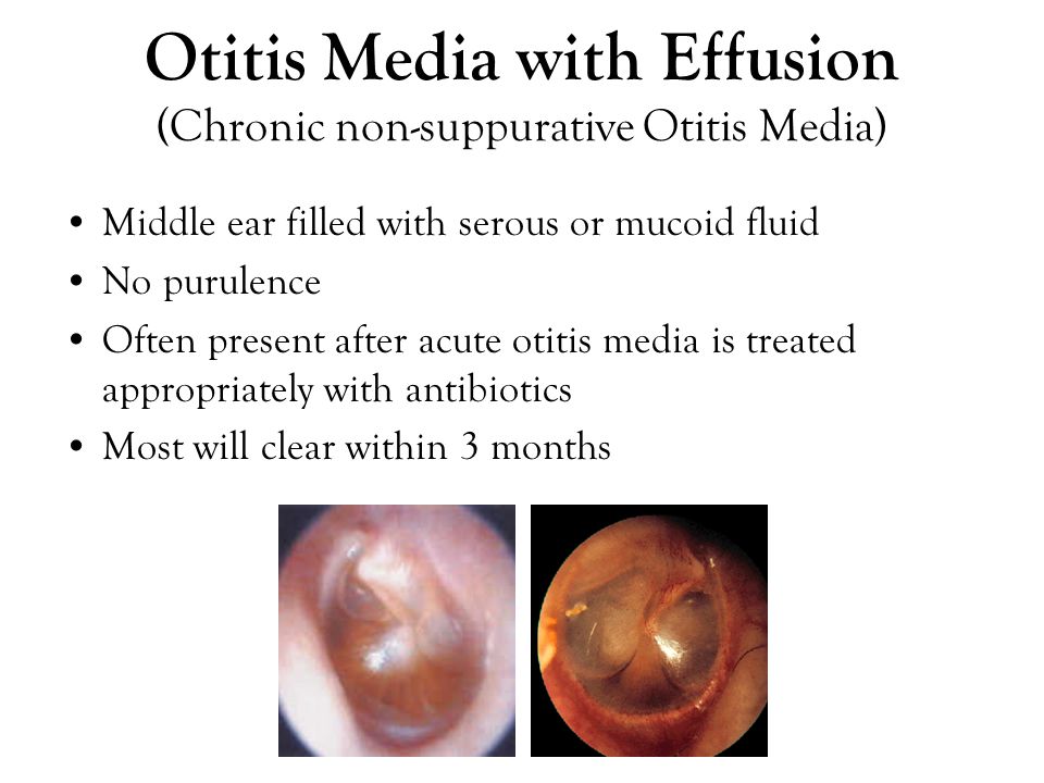 Middle ear infections treatment adults