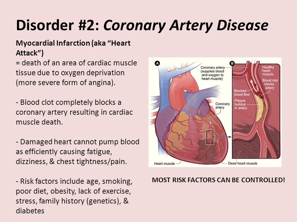 Disorder #2: Coronary Artery Disease Myocardial Infarction (aka Heart Attack ) = death of an area of cardiac muscle tissue due to oxygen deprivation (more severe form of angina).